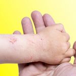 Dermatite Atopica: una crema sperimentale migliora i sintomi della malattia
